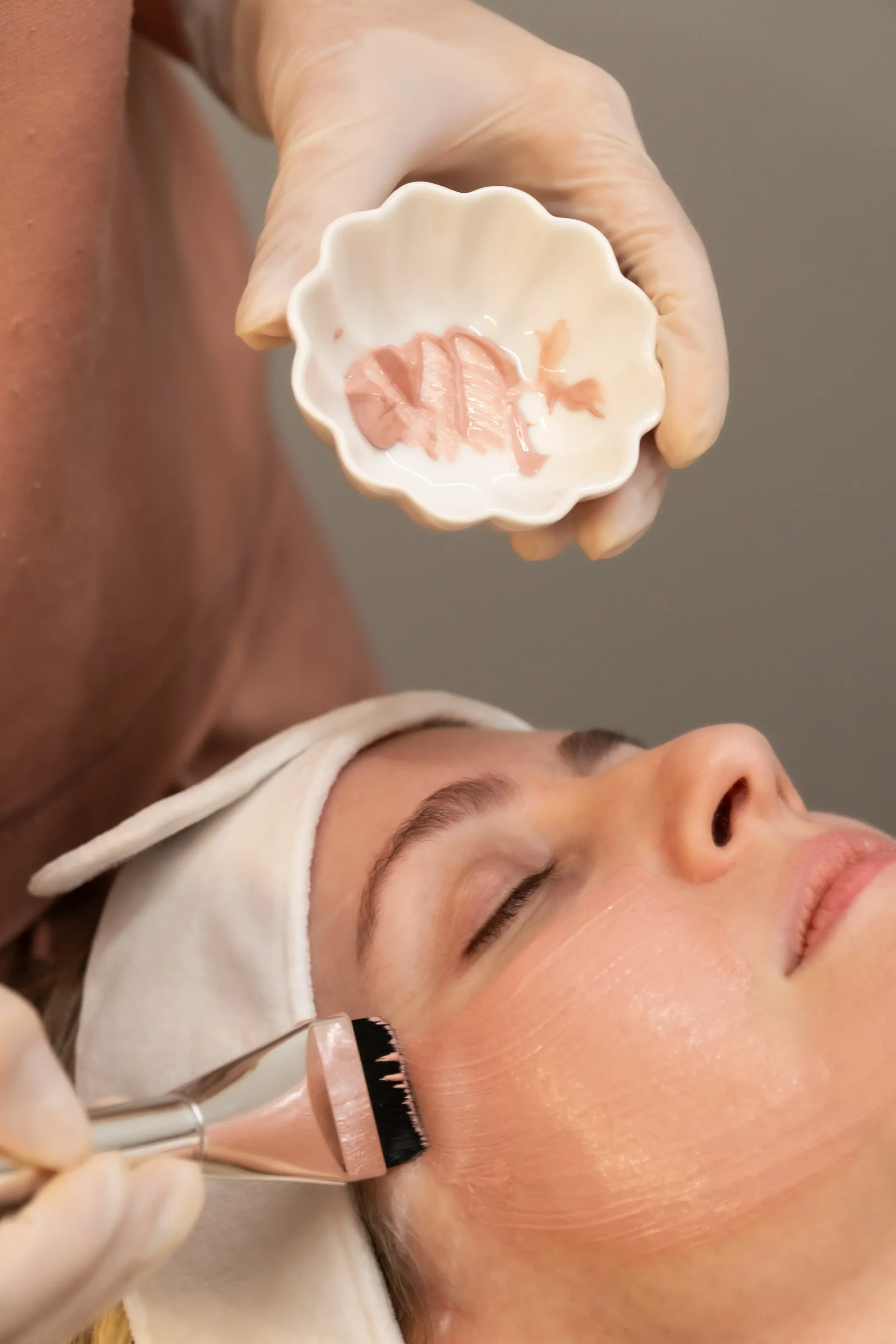 Tratamento Peelings - Peelings químicos personalizados para renovação celular, manchas, acne e textura da pele. Avaliação dermatológica em Uberlândia.